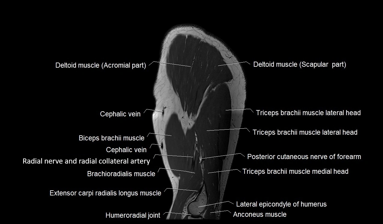 Upper arm (humerus ) saittal cross sectional anatomy 3T image 8.webp